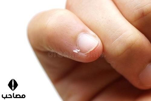 [تصویر:  1642069755_nail-skin-peeling-nail-skin-p...%20(1).jpg]